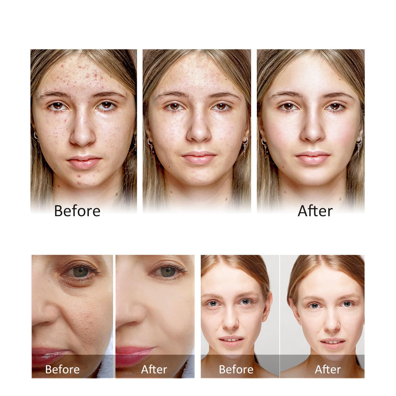 LED Whitening And Skin-Rejuvenation Spectrometer